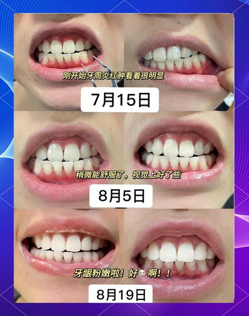 牙周治疗